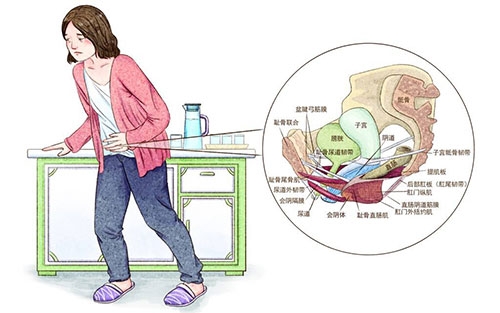 女性尿失禁的原因有哪些 尿失禁有哪些治疗方法
