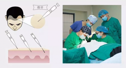 为什么这么多人选择微针植发技术?温州新生植发医院为您解答